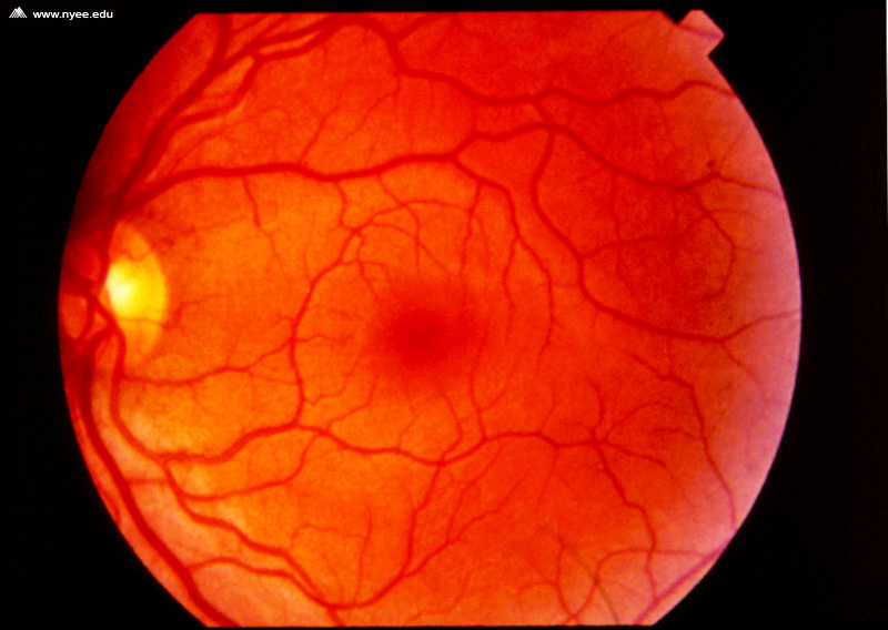 Anamolous Retinal Blood Vessels NYEE